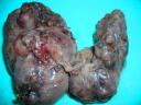 Adenomatous Goiter