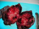 Adenomatous Goiter 2