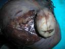 FIBROID